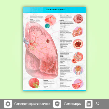 Плакат «Заболевания легких» (М-30, самоклеящаяся пленка, A2, 1 лист)